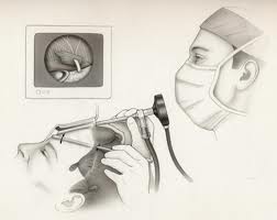 brow lift cyprus.jpg